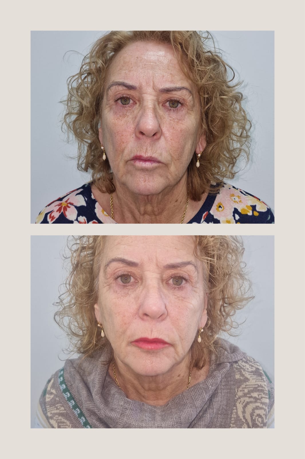 Resultado real: antes y después del tratamiento